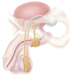 Artificial urinary sphincter diagram sourced from [Artificial Urinary Sphincter - Brisbane Urology Clinic](https://www.brisbaneurologyclinic.com.au/procedures/artificial-urinary-sphincter/)