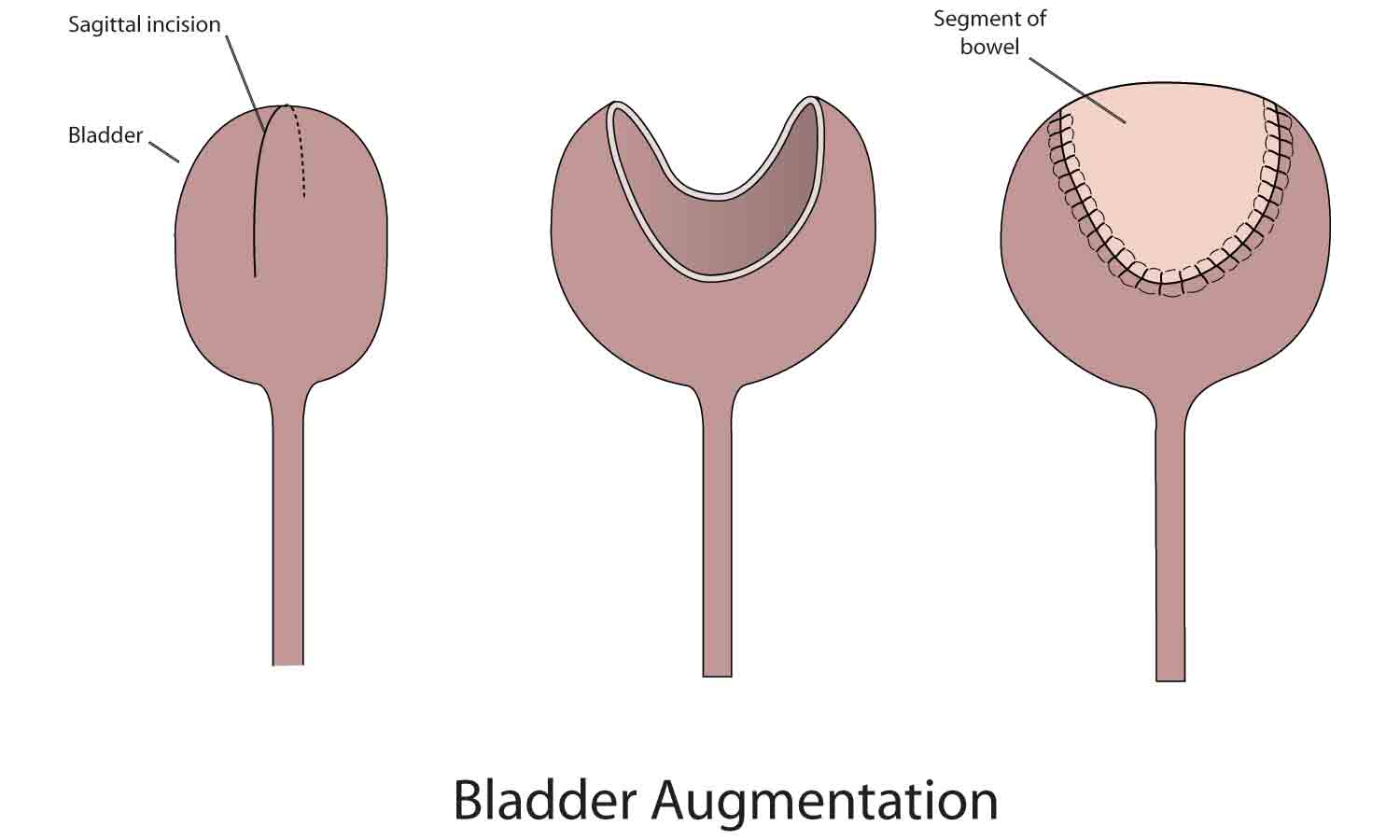 Bladder augmentation diagram sourced from [Surgical Alternatives for Bladder Management Following SCI | Model Systems Knowledge Translation Center (MSKTC)](https://msktc.org/sci/factsheets/Bladder-Management-Surgical-Alternatives)