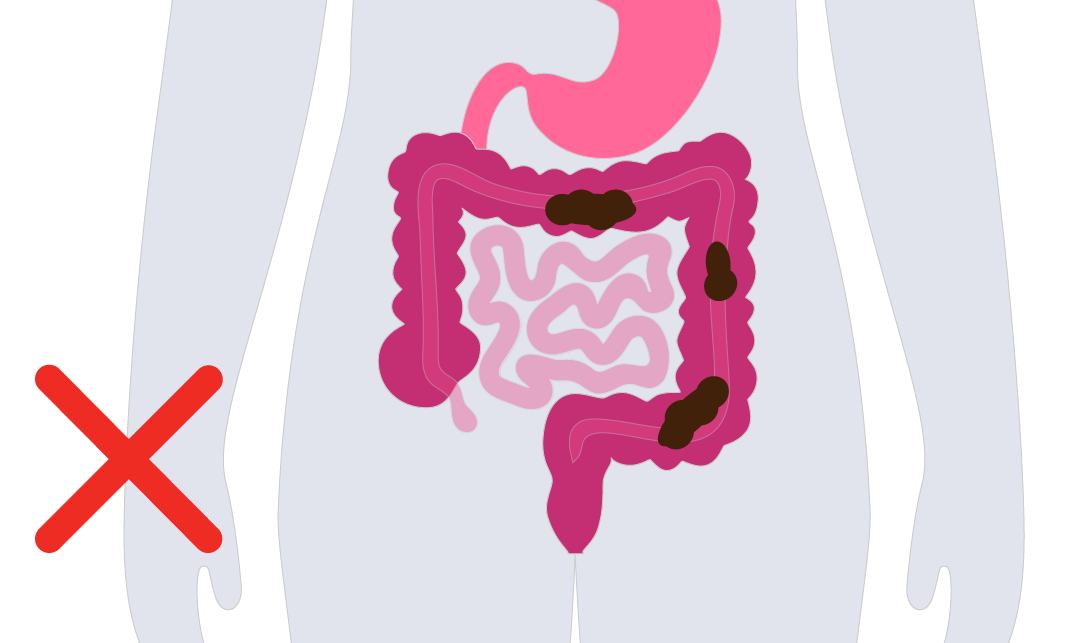 An illustration showing the position of the faeces in the bowel which is too high.