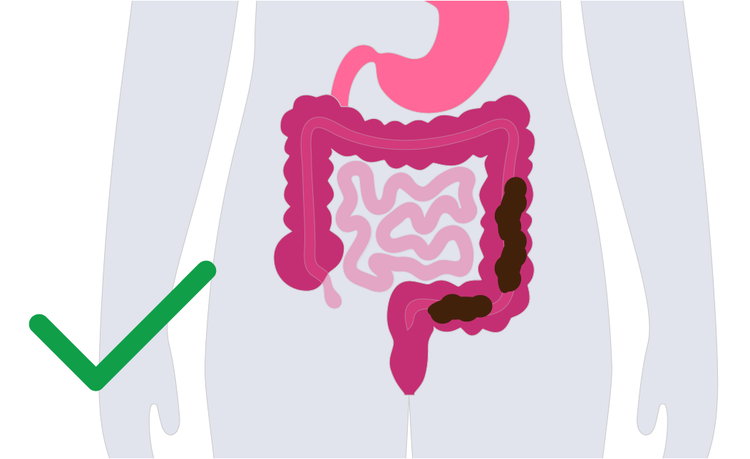 An illustration showing the position of the faeces in the bowel which is too low.