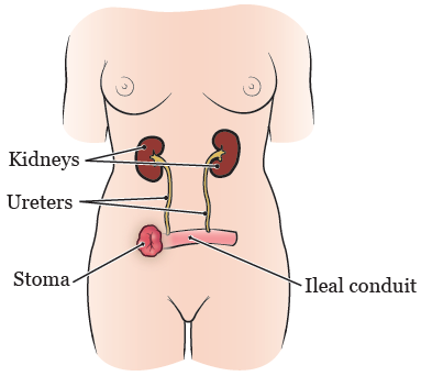 Ileal conduit diagram sourced from [About Your Bladder Surgery With an Ileal Conduit (Urostomy) | Memorial Sloan Kettering Cancer Center (mskcc.org)](https://www.mskcc.org/cancer-care/patient-education/about-your-bladder-surgery-ileal-conduit-urostomy)