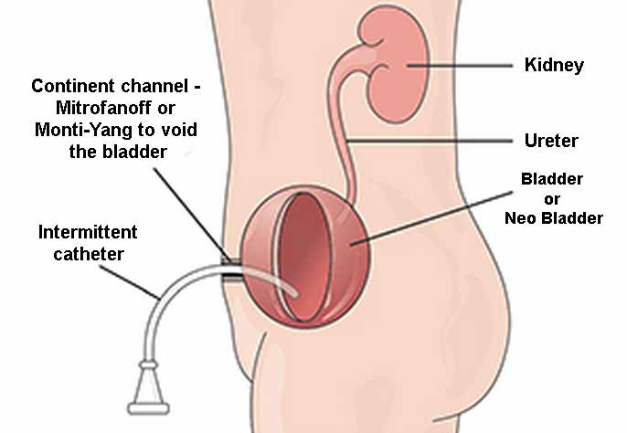 Mitrofanoff diagram sourced from [Mitrofanoff - QLD Stoma Association](https://qldstoma.asn.au/mitrofanoff/)