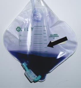 Purple Urine Bag image sourced from [Purple Urine Bag - Craig Hospital](https://craighospital.org/resources/purple-urine-bag-syndrome-pubs)